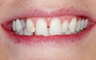 Edge Bonding - Smile 3 before